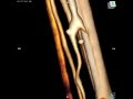 carotid brachial bypass and radiocephalic avf creation