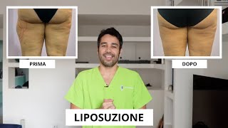 Liposuzione