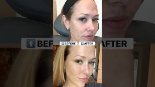 BBL + MOXI Laser healing journey: laser results #bbllaser #moxilaser