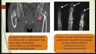 Les manifestations osseuses des parathyroïdies