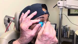 Taking an EyePrint Impression Of An Eye With Advanced Keratoconus