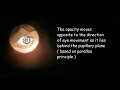 zonular cataract video compilation of distant direct ophthalmoscopy slit lamp examination