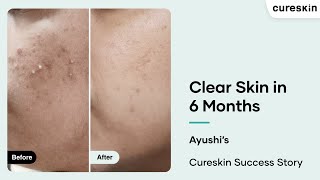 How Ayushi Transformed Her Skin with Cureskin | Acne \u0026 Dark Spots| Cureskin