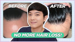 How I STOPPED My RECEDING HAIRLINE: My Hair Loss Treatment Journey (Filipino) |