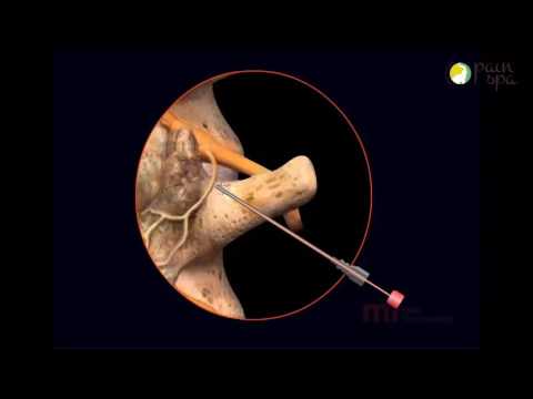 Lumbar Radiofrequency Ablation Procedure - YouTube