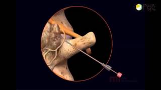 Lumbar Radiofrequency Ablation Procedure