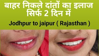 बहार निकले हुए दांतों का इलाज//smile design treatment/Jodhpur to jaipur Rajasthan for smile makeover