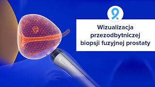 Wizualizacja przezodbytniczej biopsji fuzyjnej prostaty - KOELIS TRINITY