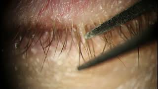 Eyelid Viral Papilloma Eyelash Horn