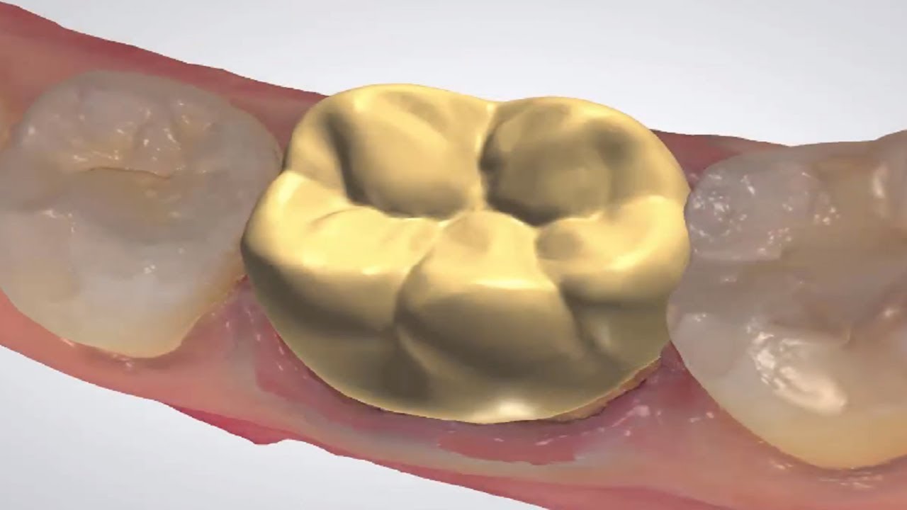 3Shape Dental System - Full Anatomical Crown On TRIOS Scan - YouTube