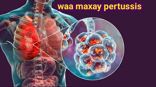 Caabuqa ku dhaca habdhiska neef-mareenka ee whooping cough 😷 calaamadaha lagu garto