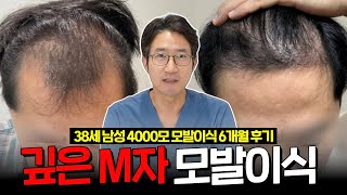 M자탈모 .. 중년 남성 최대 고민! 30-40대 모발이식 후기! | 더이상 살랑거리는 머리카락으로 가리지 마세요!!