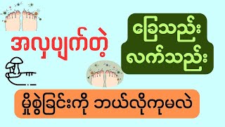 အလှပျက်တဲ့ ခြေသည်းလက်သည်းမှိုစွဲခြင်းကို ဘယ်လိုကုမလဲ?