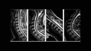 MRI and Spine Modeling by Dr. Jerome Fryer - Dynamic Disc Designs