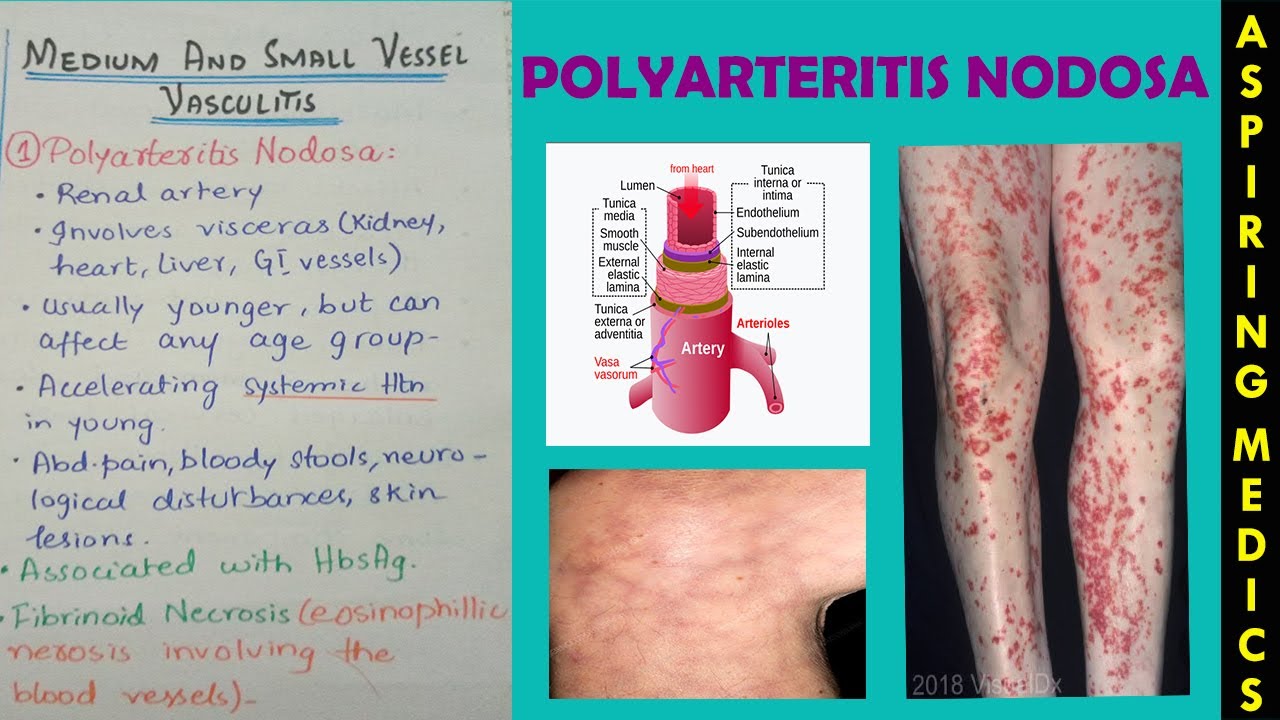 Polyarteritis Nodosa Pathology Lecture-Vasculitis Part 2 [ASPIRING ...