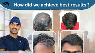 Hair Transplant In Bangalore | Best Surgeon Center \u0026 Results Of Hair Transplant In Bangalore