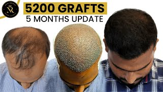Grade 6 Hair Transplant Result | 5000 Grafts Hair Transplant |