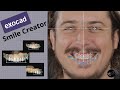 Exocad - Smile Creator