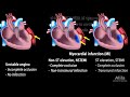 Acute Coronary Syndrome Unstable Angina, NSTEMI and STEMI (Heart Attack), Animation