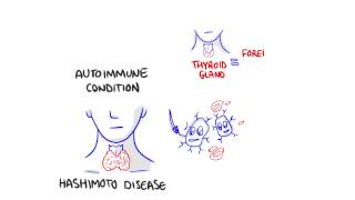 Some facts about Hashimotos disease