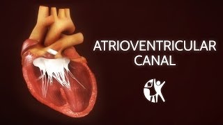 Atrioventricular Septal Defect - AV Canal