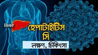 হেপাটাইটিস সি এর লক্ষণ, রোগ নির্ণয় ও চিকিৎসা । হেপাটাইটিস সি লক্ষণসমূহ।