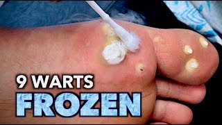 9 WARTS FROZEN on 1 FOOT (with liquid nitrogen) | Dr. Paul