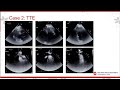 Low-Field Cardiovascular MRI