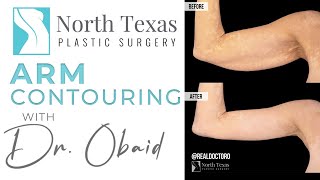 Arm Contouring