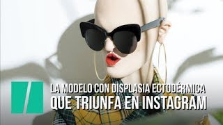 La modelo con una rara enfermedad genética que triunfa en Instagram