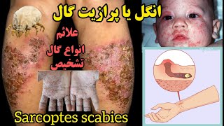 بیماری #انگلی #گال یا #scabies، انواع آن، علائم آن، و روش تشخیص آن. #sarcoptes #scabies