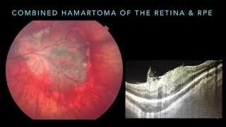 Intraocular Tumors 101