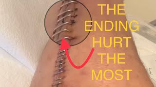 Getting 61 surgical staples removed ORIF surgery