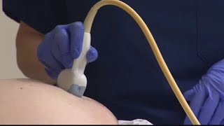 ACLU, doctors challenge Georgia's abortion law