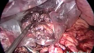 Laparoscopic Pancreatic Necrosectomy for infected pancreatic necrosis after acute pancreatitis Laparoscopic Pancreatic Necrosectomy for infected pancreatic necrosis after acute pancreatitis