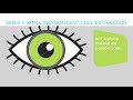 SMILE eye surgery explanation