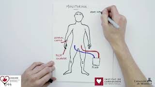 Differential Hypoxemia Veno-Arterial ECMO