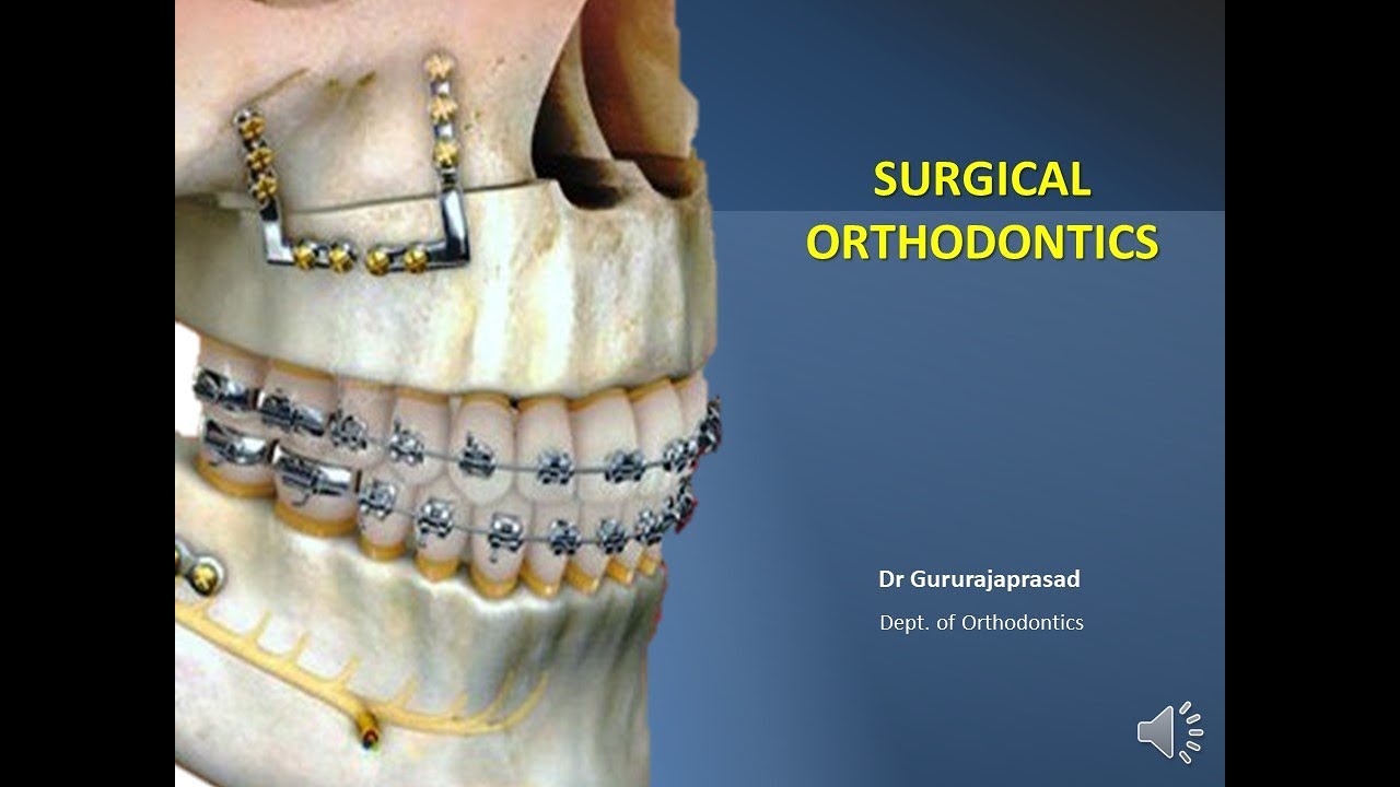 Surgical Orthodontics - YouTube