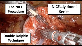 NICE...ly Done! How To Secure The Anvil Using The Double Dolphin Purse-String Suture Technique