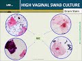 High Vaginal Swab (HVS) culture