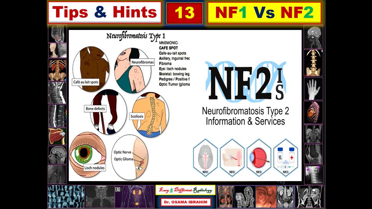 Nf1 Vs Nf2 Tips Hints 13 Youtube