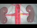 Percutaneous Transluminal Renal Angioplasty (PTRA) AIIMS Bhubaneswar cardiology team