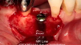 Implantation of NR Line in 3wall defect narrow ridge.