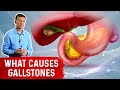 What Really Causes Gallstones? - Dr. Berg