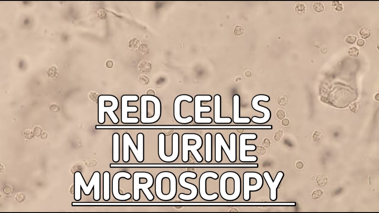 Red Blood Cells Seen In Urine Microscopy.Hematuria.Urine Routine ...