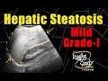 Mild Hepatic Steatosis || Mild Fatty Infiltration || Ultrasound || Case 170