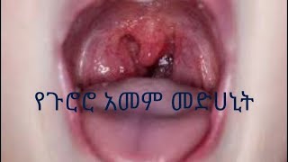 ለጉሮሮ ህመም የሚሆን በቤትዉሰጥ የሚዘጋጅ መድሀኒት