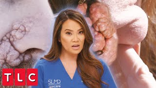 The Most Insane Removals from Season 8! | Dr. Pimple Popper