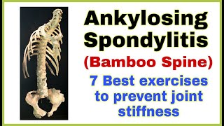 Ankylosing spondylitis  (BAMBOO SPINE) exercises in hindi | HLA b27 exercises