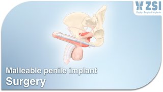 13. Penile implant surgery (malleable version, ref: ZSI 100)